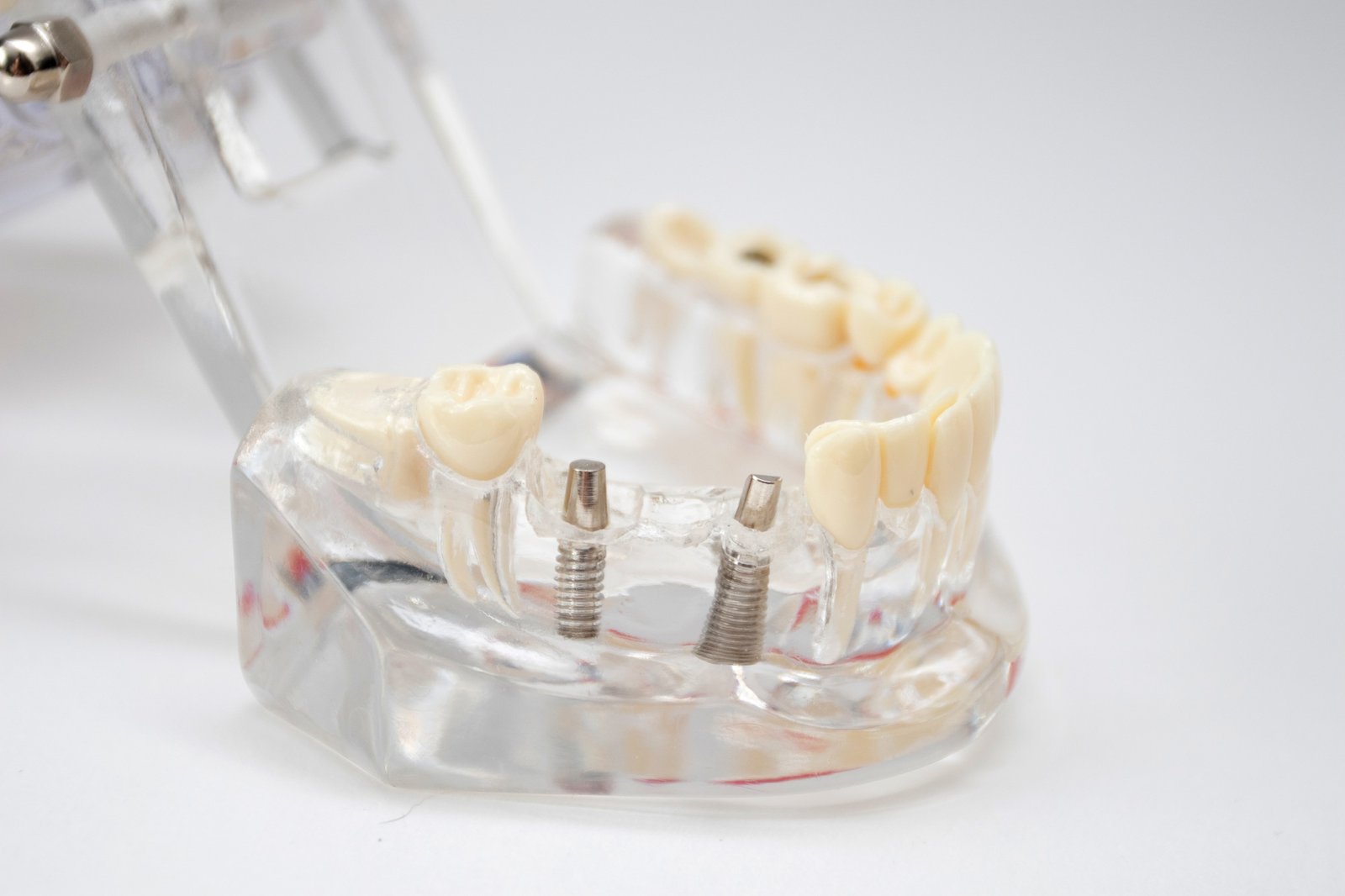 A demonstration jaw with an implants teeth and an abutment