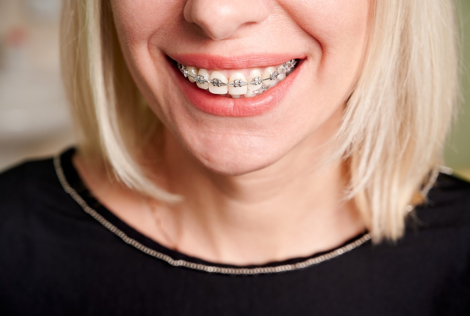 Blonde woman with metal braces on teeth.