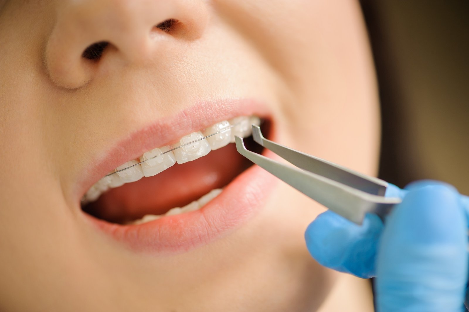 Woman with ceramic braces on teeth at the dental office